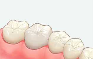 被せ物の場合