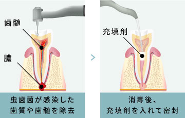 虫歯菌が感染した歯質や歯髄を除去。消毒後、充填剤を入れて密封