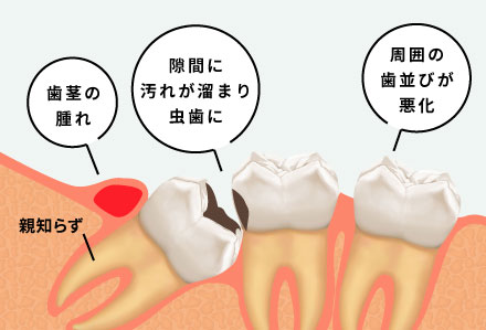 歯茎の腫れ、隙間に汚れが溜まり虫歯に、周囲の歯並びが悪化